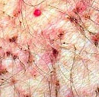 360°全面解析：包皮炎